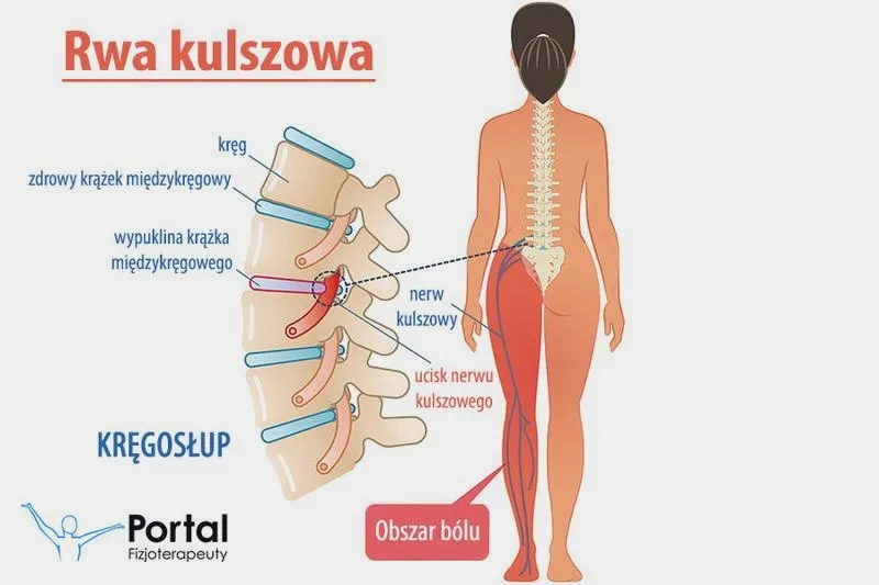 Czy bieganie jest bezpieczne przy rwie kulszowej? Sprawdź nasze wskazówki!