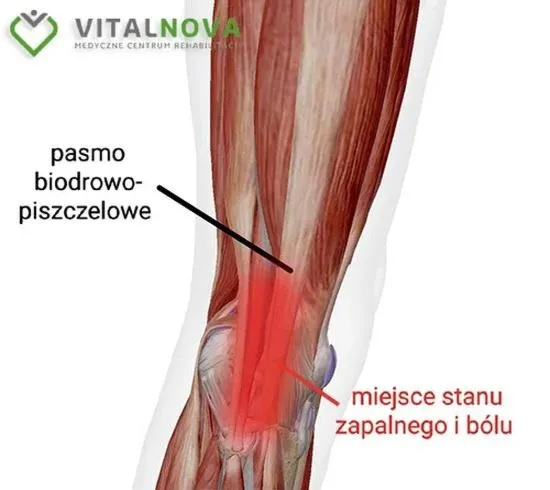 Dlaczego bolą kolana po bieganiu — przyczyny i proste sposoby zapobiegania