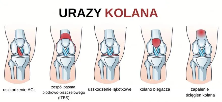 Bieganie i ból kolan