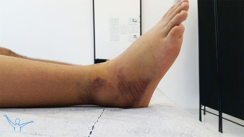 Powrót do biegania po urazie